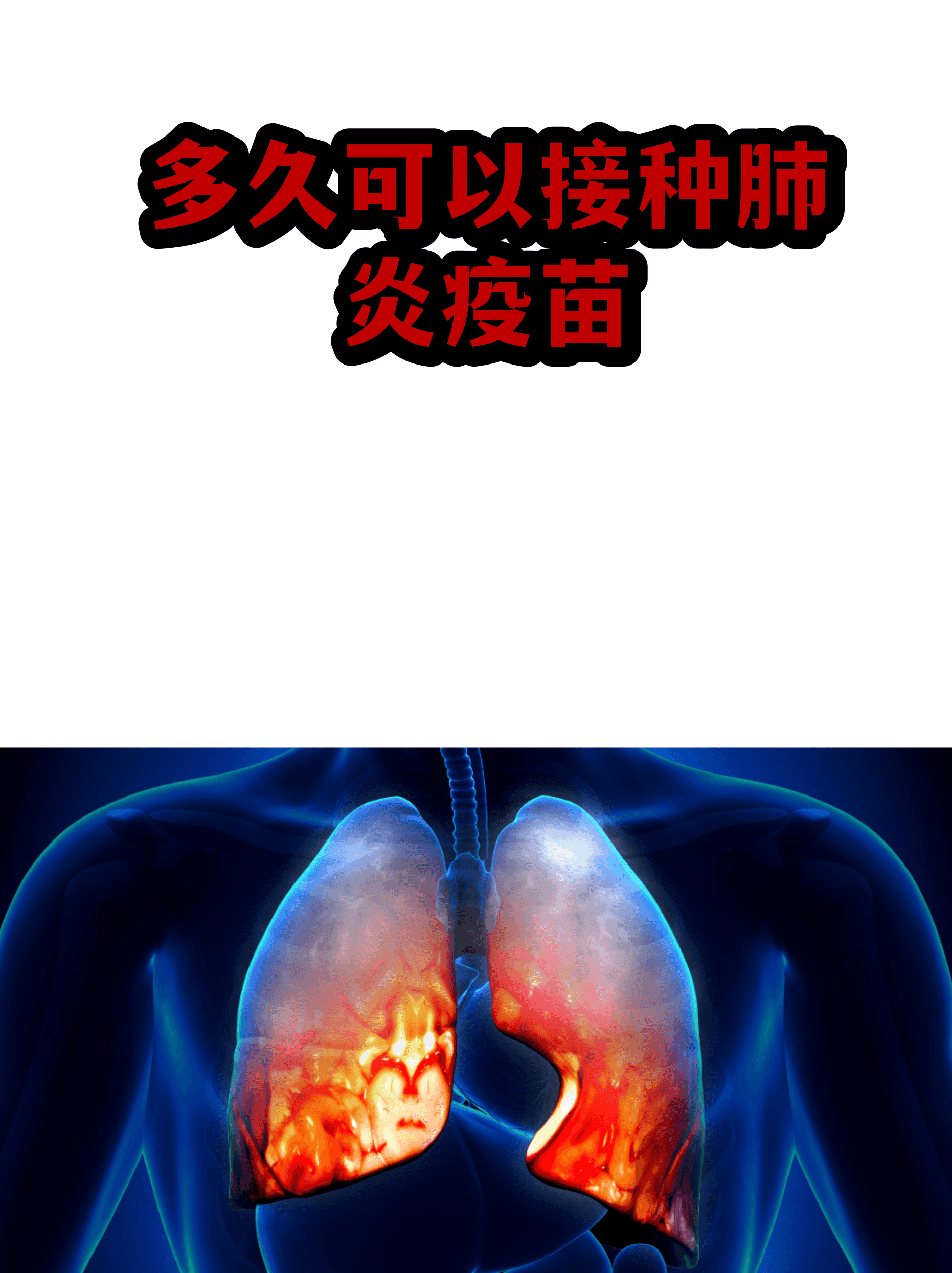 陕西肺炎〃陕西肺炎疫苗多少钱一针-第1张图片