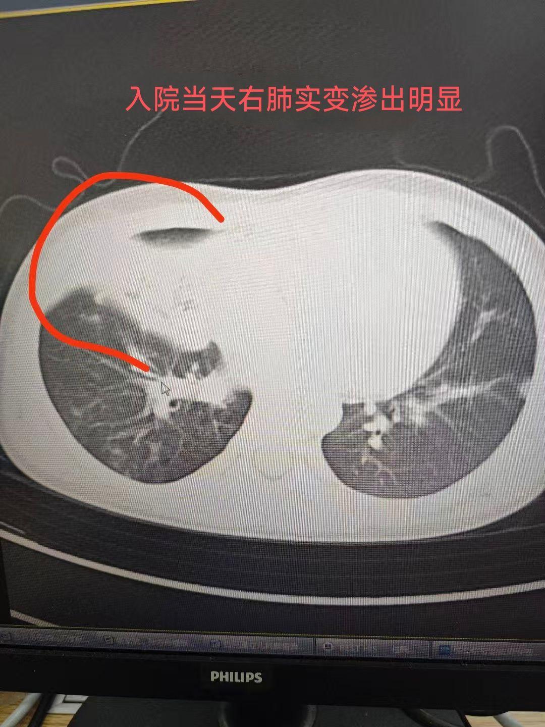 肺炎北京10例了-北京肺炎病例-第1张图片